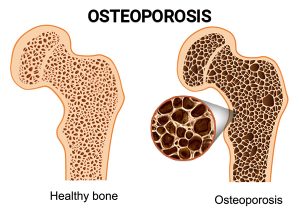 Osteoporosis